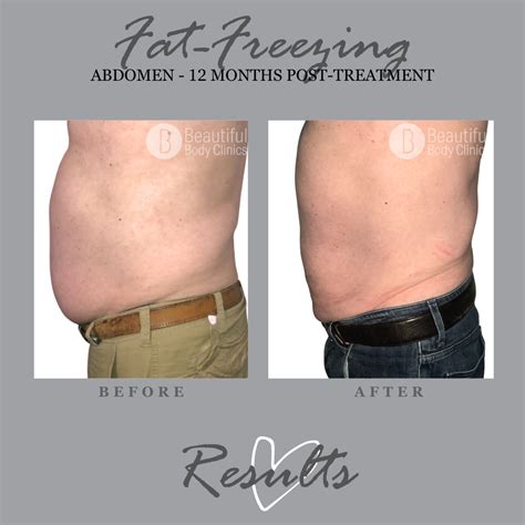 sarnia coolsculpting|Services .